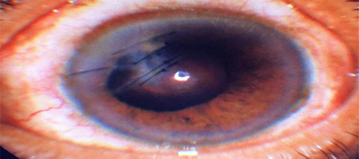 Case Report: Microsporidial Endophthalmitis after Penetrating Eye Trauma