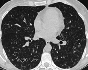 Unusual Forms of Pulmonary Hypertension