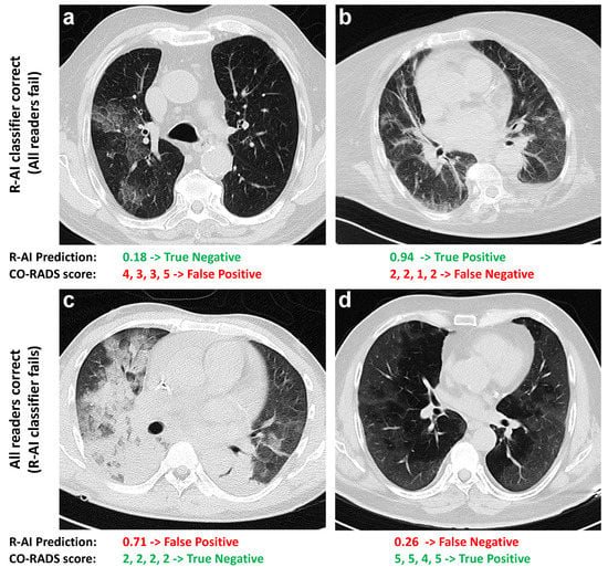 Tomography, Vol. 8, Pages 2815-2827: Diagnostic Performance in Differentiating COVID-19 from Other Viral Pneumonias on CT Imaging: Multi-Reader Analysis Compared with an Artificial Intelligence-Based Model