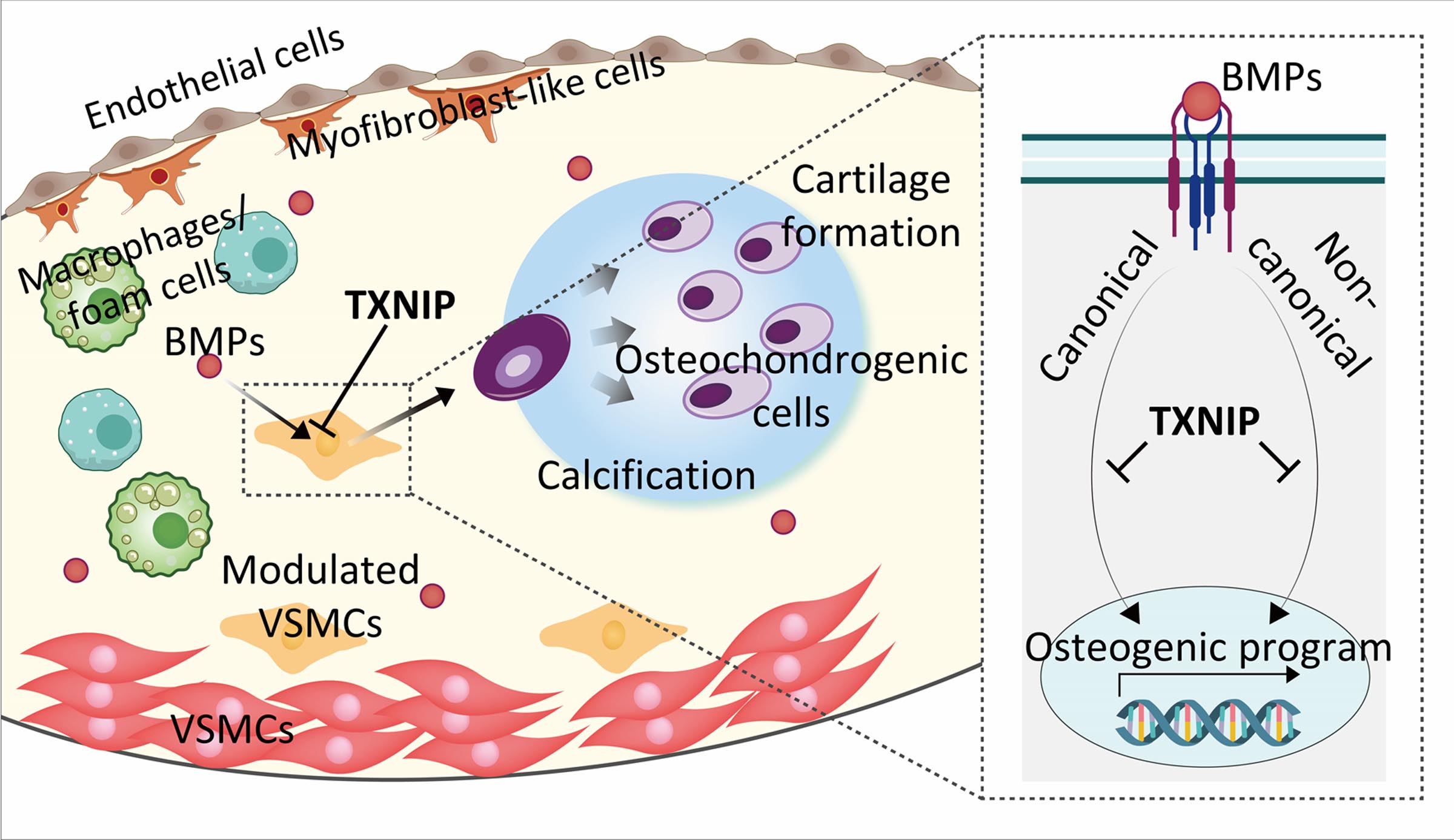 TXNIP Suppresses the Osteochondrogenic Switch of VSMCs in Atherosclerosis