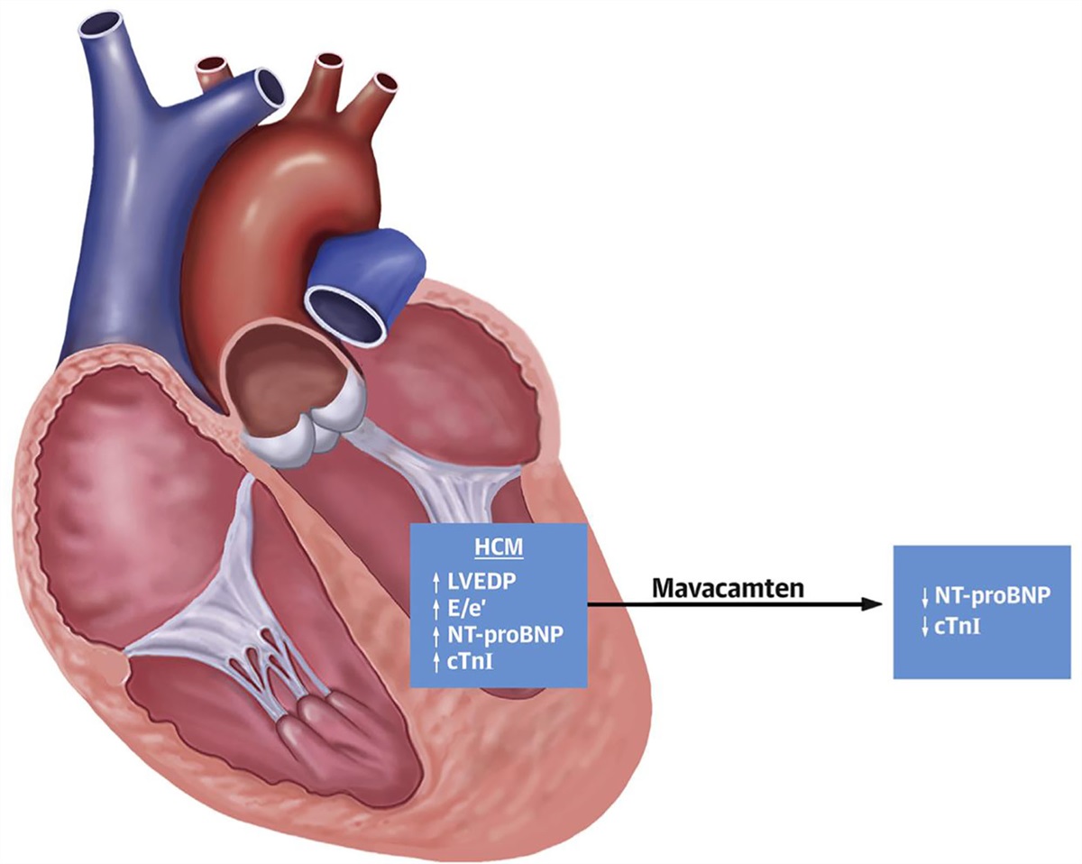 Mavacamten: A Novel Disease-Specific Treatment for Hypertrophic Cardiomyopathy
