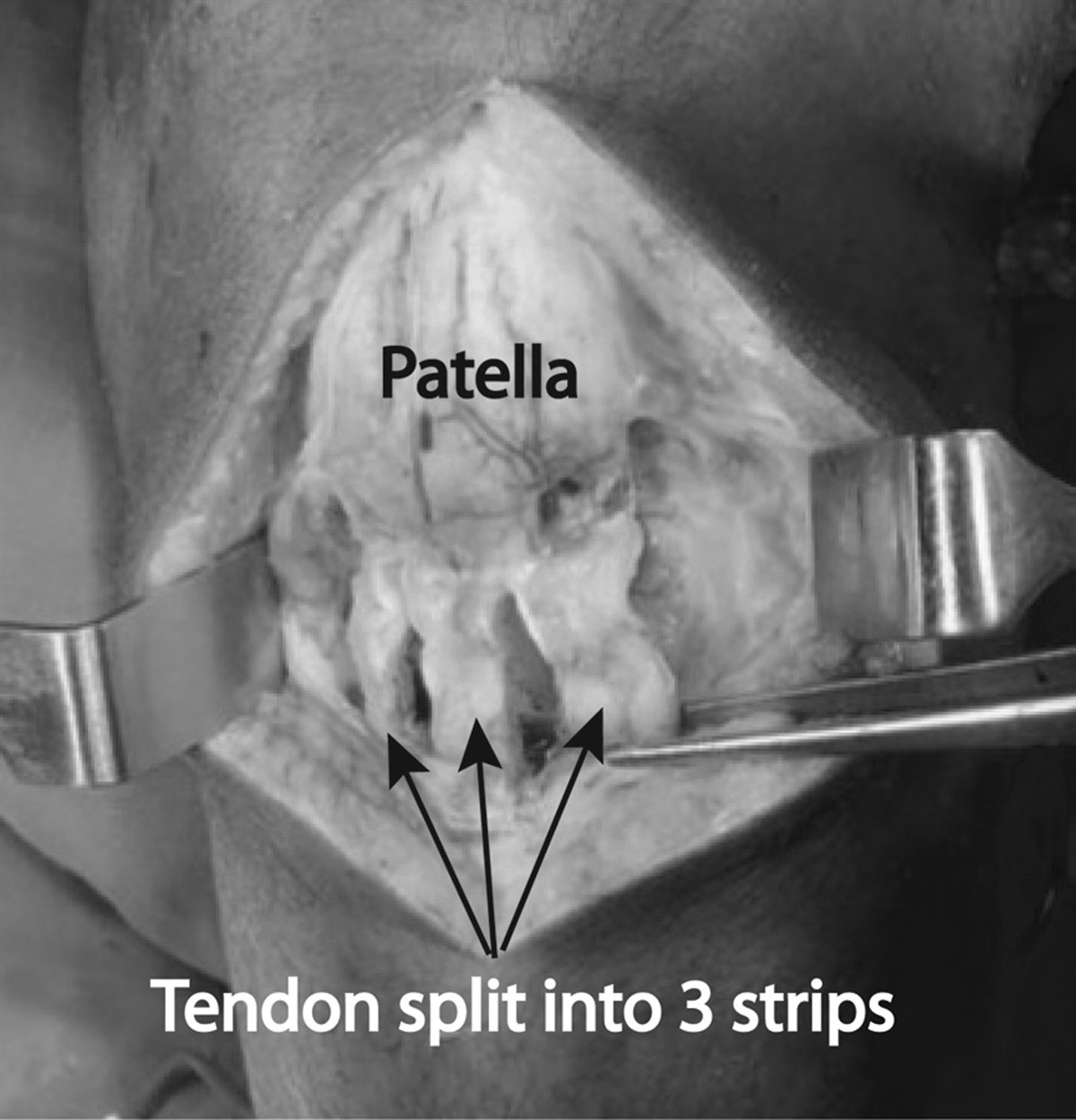 Evaluation of a technique of patellar tendon shortening to correct patella alta associated with severe crouch gait in cerebral palsy