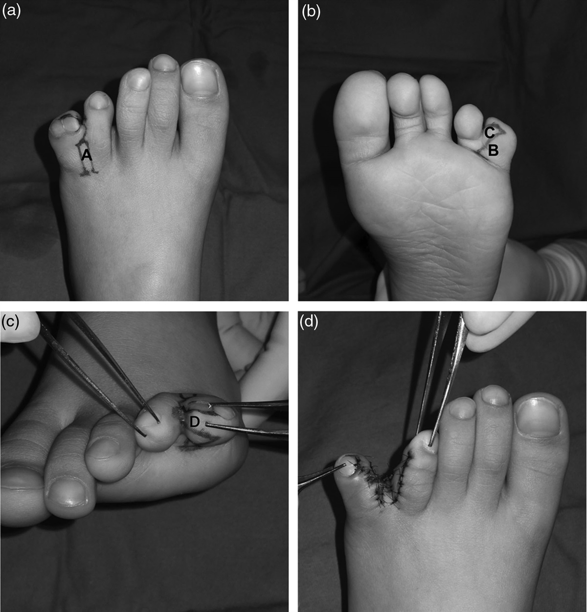 Reconstruction of polysyndactyly of the fused fifth toe with the fourth toe