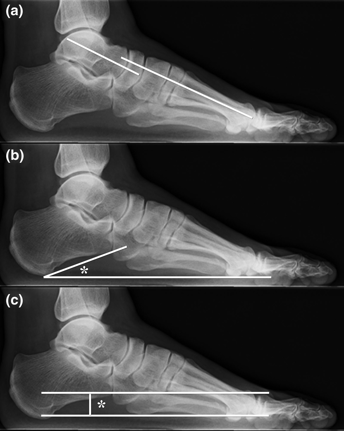 Radiographic foot alignment and morphological features of deltoid ligament in pediatric patients with medial osteochondral lesions of the talus
