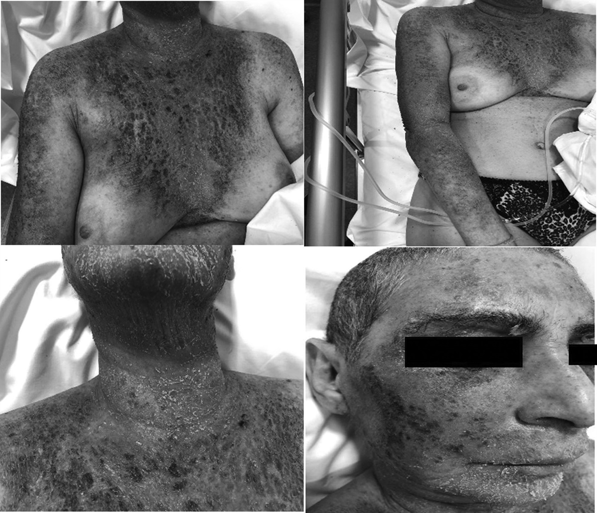 Cetuximab severe cutaneous toxicity… a gateway for bacteremia: case report