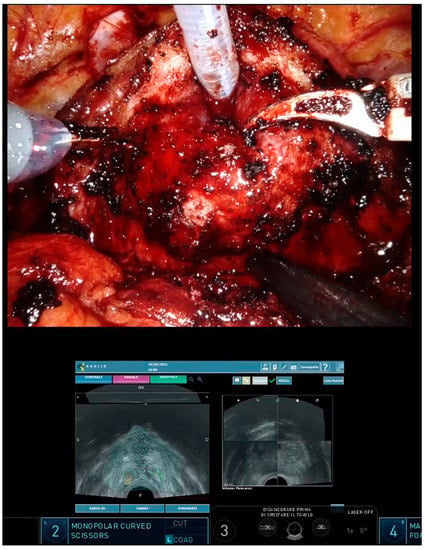 Current Oncology, Vol. 30, Pages 110-117: Intraoperative 3D-US-mpMRI Elastic Fusion Imaging-Guided Robotic Radical Prostatectomy: A Pilot Study