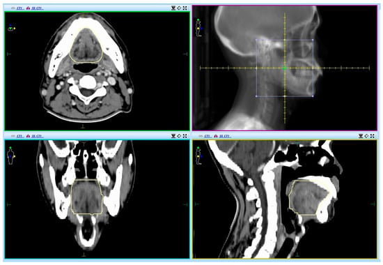 Current Oncology, Vol. 30, Pages 219-232: Predicting Nomogram for Severe Oral Mucositis in Patients with Nasopharyngeal Carcinoma during Intensity-Modulated Radiation Therapy: A Retrospective Cohort Study