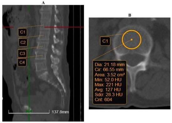 JCM, Vol. 12, Pages 153: Osteoporosis Assessment among Adults with Liver Cirrhosis