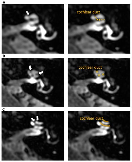 JCM, Vol. 12, Pages 202: Reliability of Endolymphatic Hydrops Qualitative Assessment in Magnetic Resonance Imaging