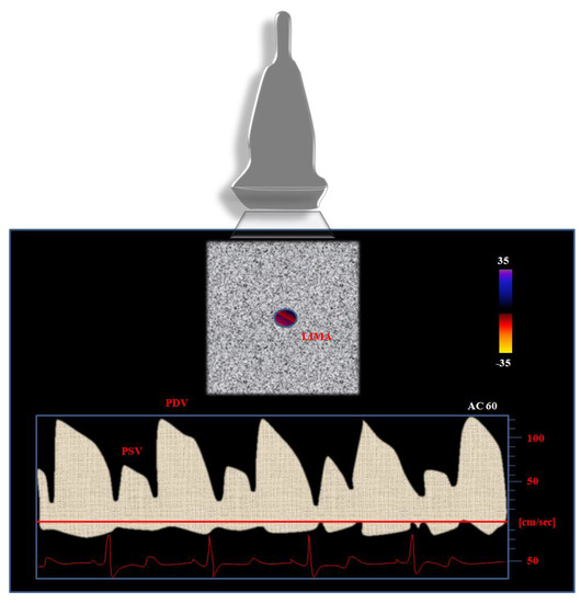 Biomedicines, Vol. 11, Pages 66: Doppler Ultrasound Selection and Follow-Up of the Internal Mammary Artery as Coronary Graft