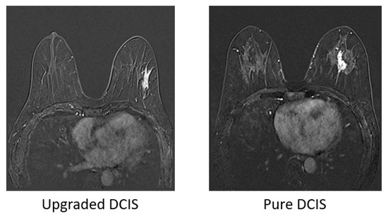 Tomography, Vol. 9, Pages 1-11: Predicting Underestimation of Invasive Cancer in Patients with Core-Needle-Biopsy-Diagnosed Ductal Carcinoma In Situ Using Deep Learning Algorithms