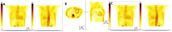 Diagnostics, Vol. 13, Pages 83: Role of Diphosphonates Bone Scintigraphy in Correlation with Biomarkers for a Personalized Approach to ATTR Cardiac Amyloidosis in North-Eastern Romania