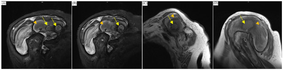 Diagnostics, Vol. 13, Pages 82: Differential Diagnosis of Thoracoacromial Artery Pseudoaneurysm from Shoulder Inflammatory Pseudotumor: A Case Report