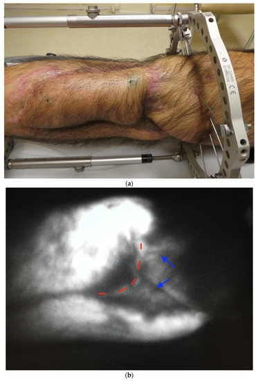 JCM, Vol. 12, Pages 229: Spontaneous Lymph Flow Restoration in Free Flaps: A Pilot Study