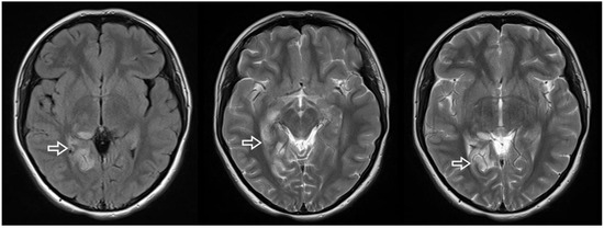 Diagnostics, Vol. 13, Pages 97: Cor Triatriatum Sinister Presenting as Cardioembolic Stroke in a Young Woman