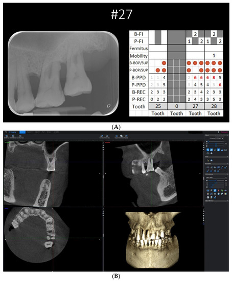 Diagnostics, Vol. 13, Pages 106: Comparison between Conventional Modality Versus Cone-Beam Computer Tomography on the Assessment of Vertical Furcation in Molars