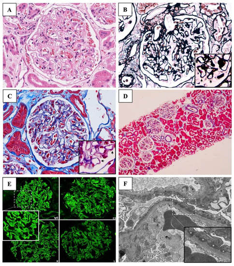 Vaccines, Vol. 11, Pages 80: Membranous Nephropathy following Full-Dose of Inactivated SARS-CoV-2 Virus Vaccination: A Case Report and Literature Review