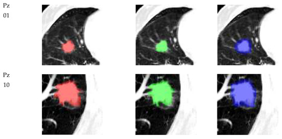 JPM, Vol. 13, Pages 83: Robustness of Radiomics in Pre-Surgical Computer Tomography of Non-Small-Cell Lung Cancer