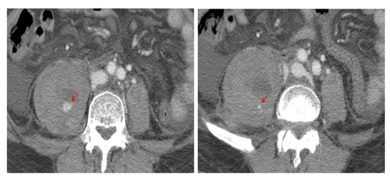 Diagnostics, Vol. 13, Pages 115: Lumbar Plexus Palsy Caused by Massive Psoas Hematoma Related to Vertebral Compression Fracture in a Patient with Liver Cirrhosis