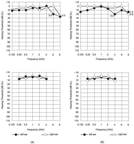Diagnostics, Vol. 13, Pages 122: Assessment of Hearing and Vestibular Functions in a Post-COVID-19 Patient: A Clinical Case Study
