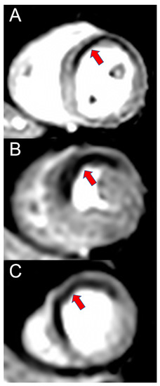 Diagnostics, Vol. 13, Pages 125: Coronary Computed Tomography vs. Cardiac Magnetic Resonance Imaging in the Evaluation of Coronary Artery Disease