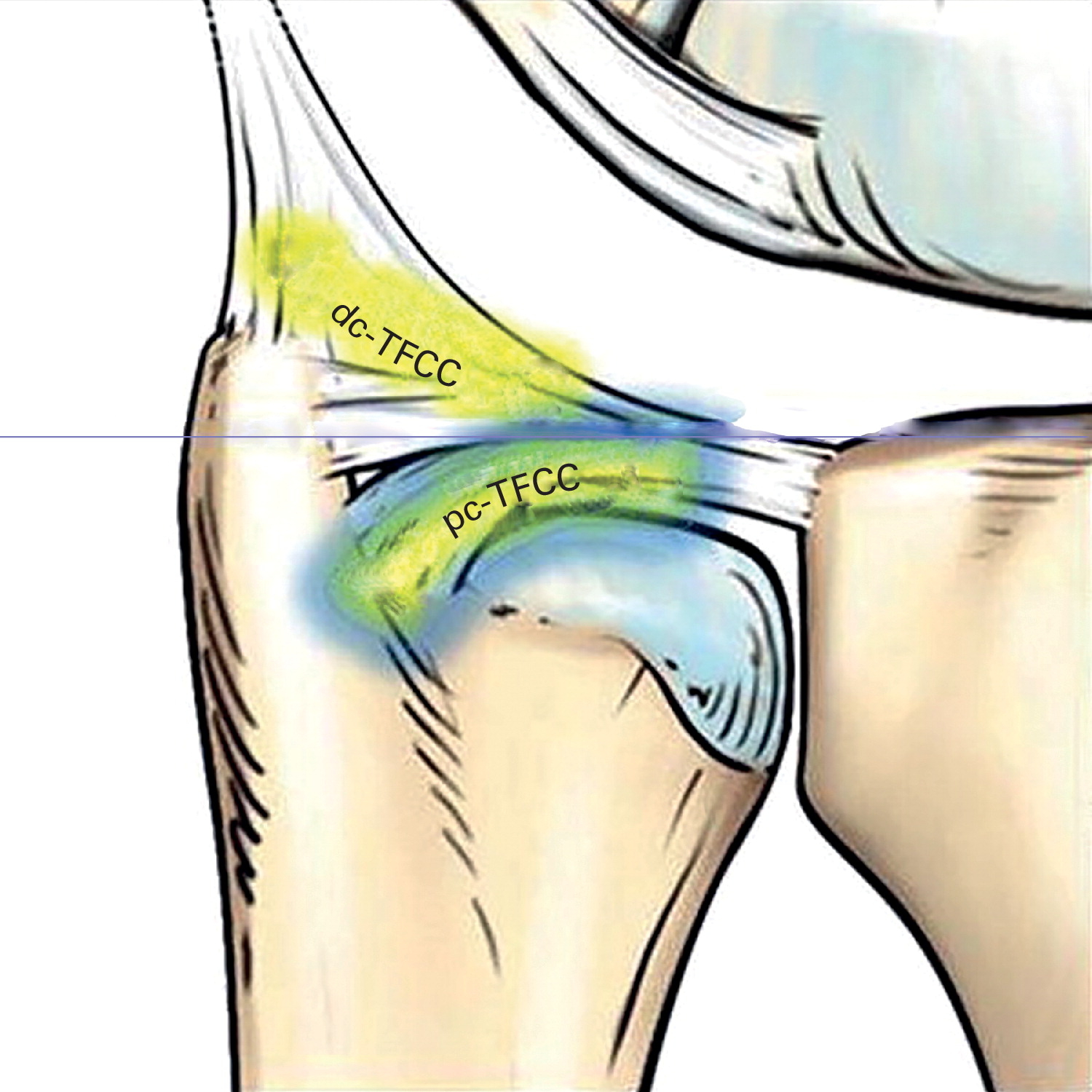 Structurally intact and functionally incompetent foveal triangular fibrocartilage complex injuries