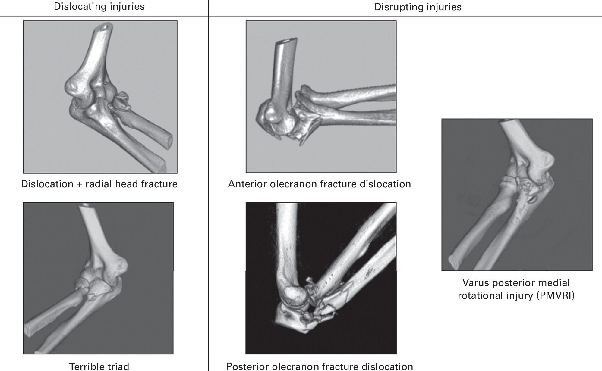 Recognition of the pattern of complex fractures of the elbow using 3D-printed models