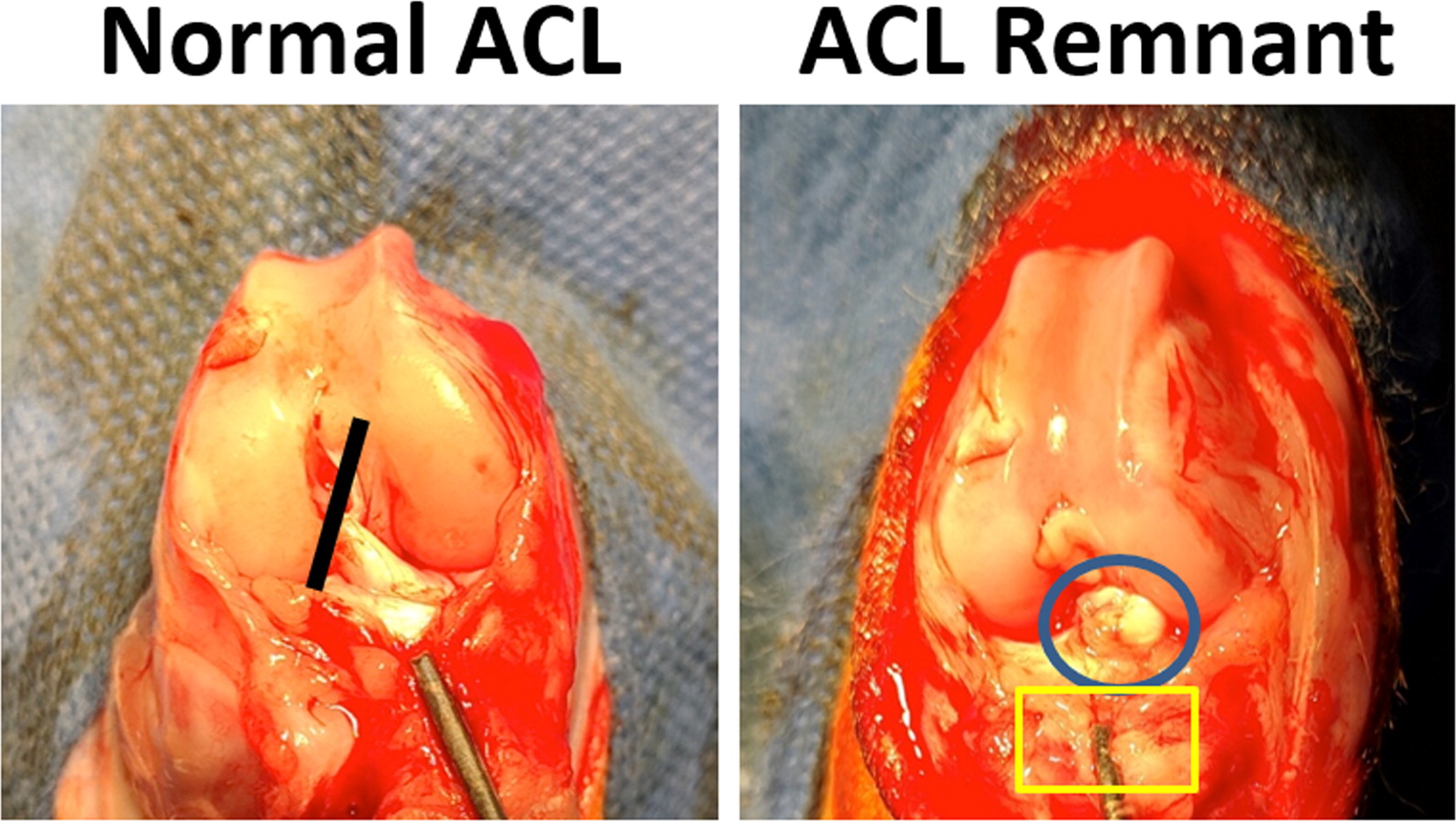 Anterior cruciate ligament remnant preservation attenuates apoptosis and enhances the regeneration of hamstring tendon graft