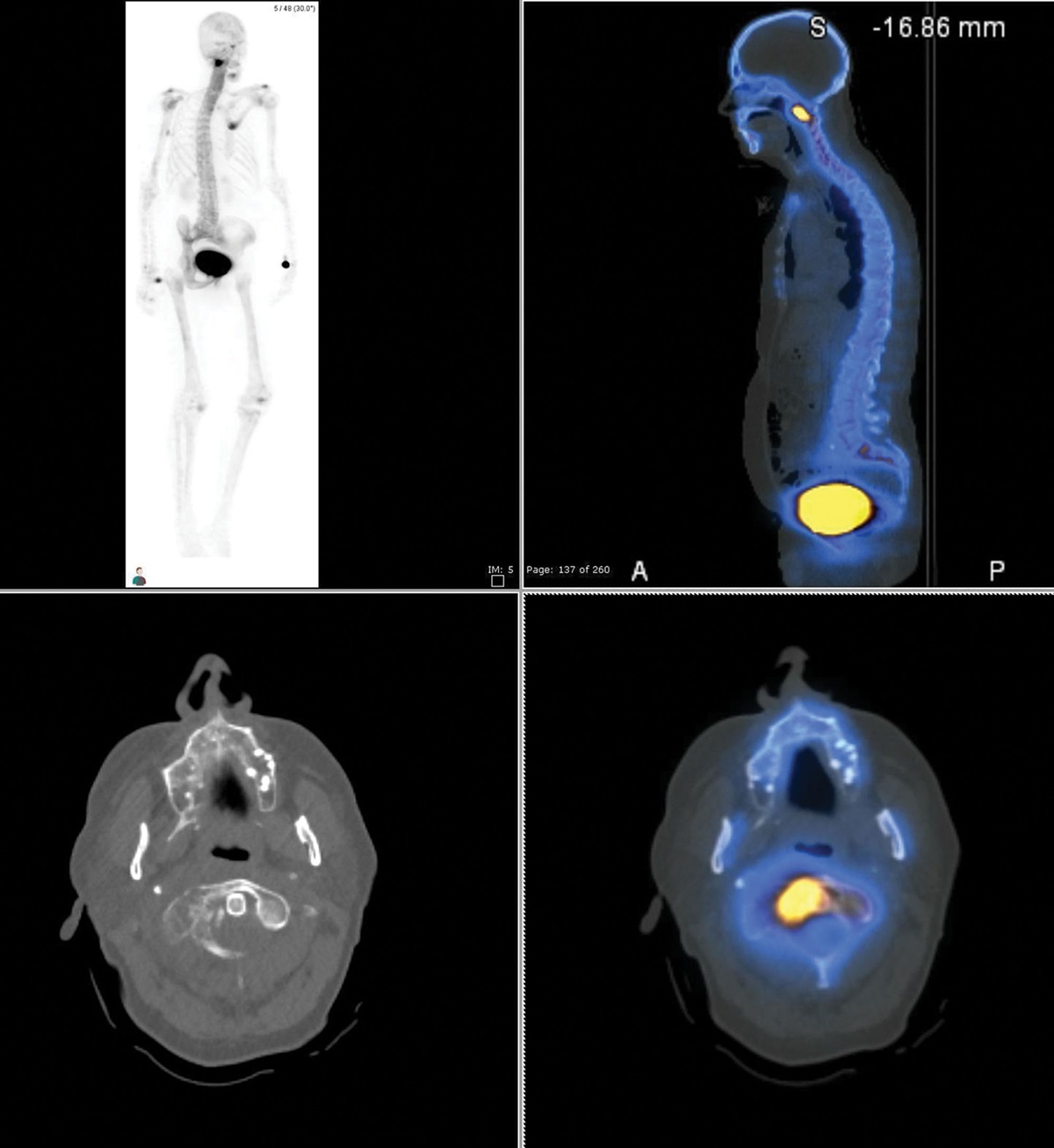 Whole-body single photon emission computed tomography/computed tomography for assessment of oncological bone disease – is an extended field of view (from vertex to toes) of clinical value?
