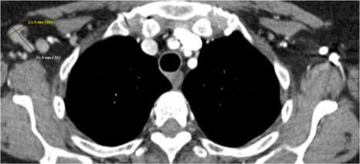 Prevalence of Adenopathy at Chest Computed Tomography After Vaccination for Severe Acute Respiratory Syndrome Coronavirus 2