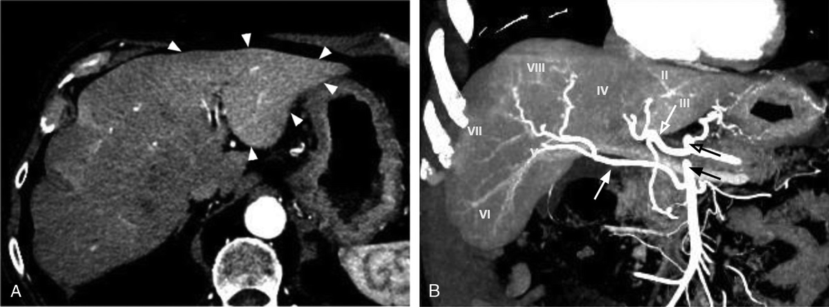 Lesion or Pseudolesion? A Comprehensive Description of Perfusion-Based Liver Alterations on Contrast-Enhanced Computed Tomography and Literature Review