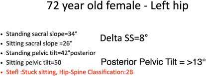 Functional Component Positioning in Total Hip Arthroplasty and the Role of Robotic-Arm Assistance in Addressing Spinopelvic Pathology