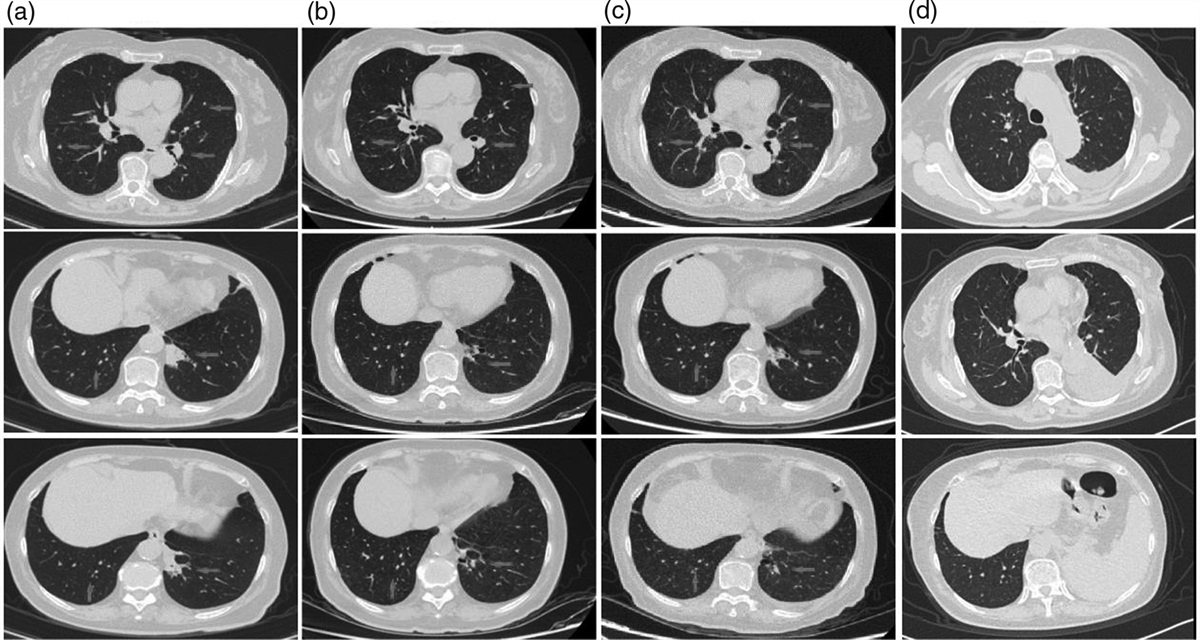 A case of lung adenocarcinoma with MET∆ex14 mutation regressed after preoperative treatment with savolitinib, and successfully underwent radical resection