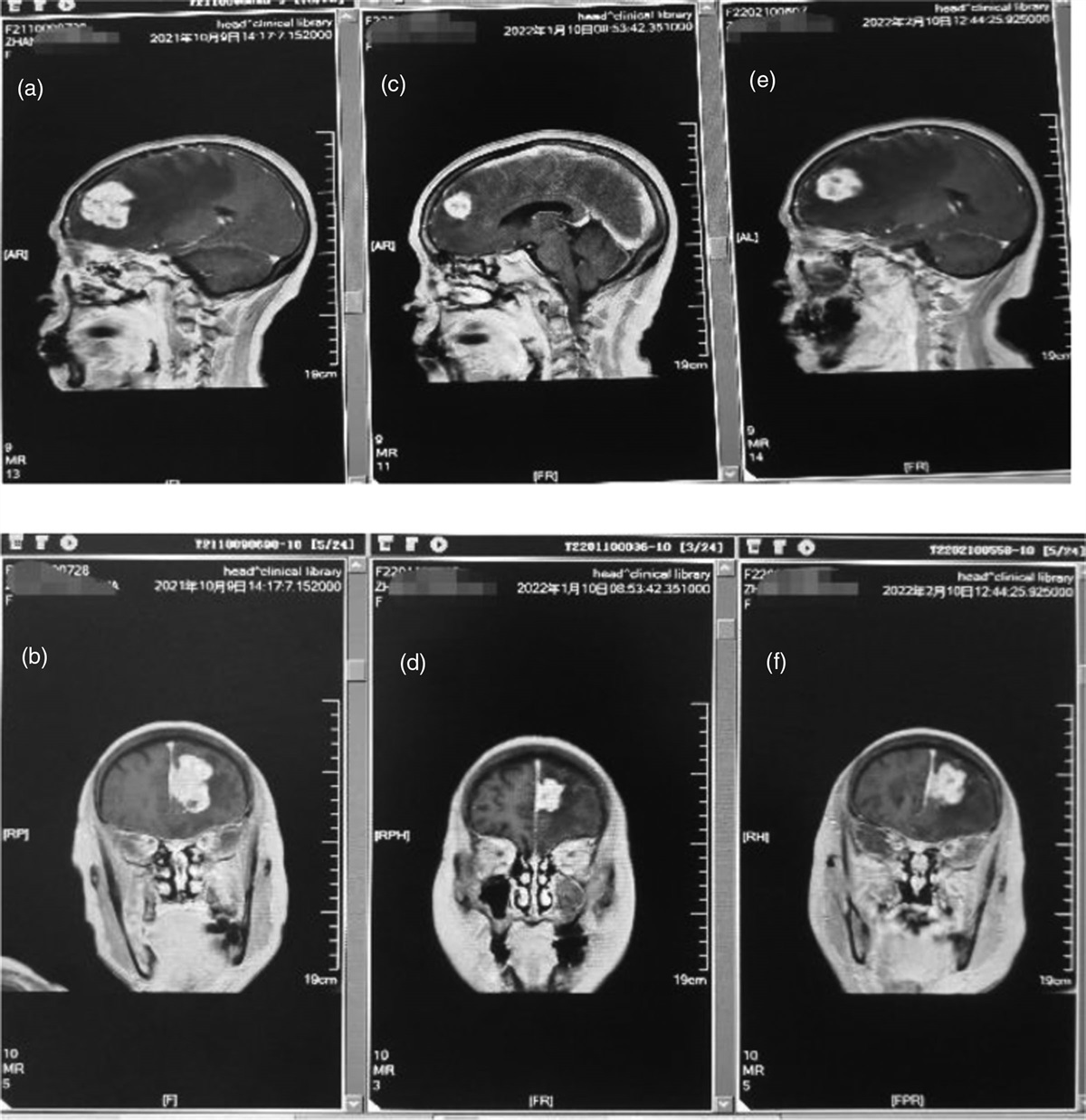 Combination toripalimab and bevacizumab for an elderly urothelial carcinoma patient with brain metastasis who failed rapidly after radiotherapy: a case report and literature review