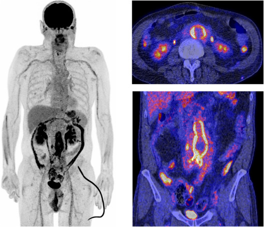 Positron Emission Tomography Imaging in Vasculitis