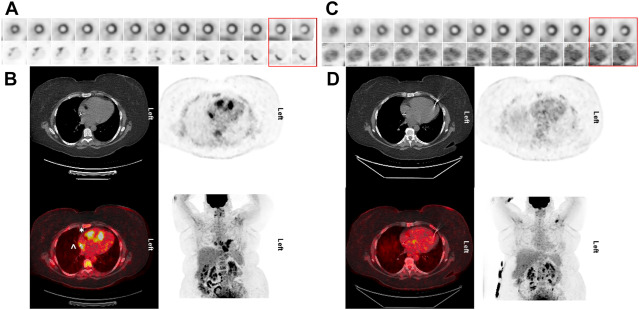 Radionuclide Assessment of Sarcoidosis