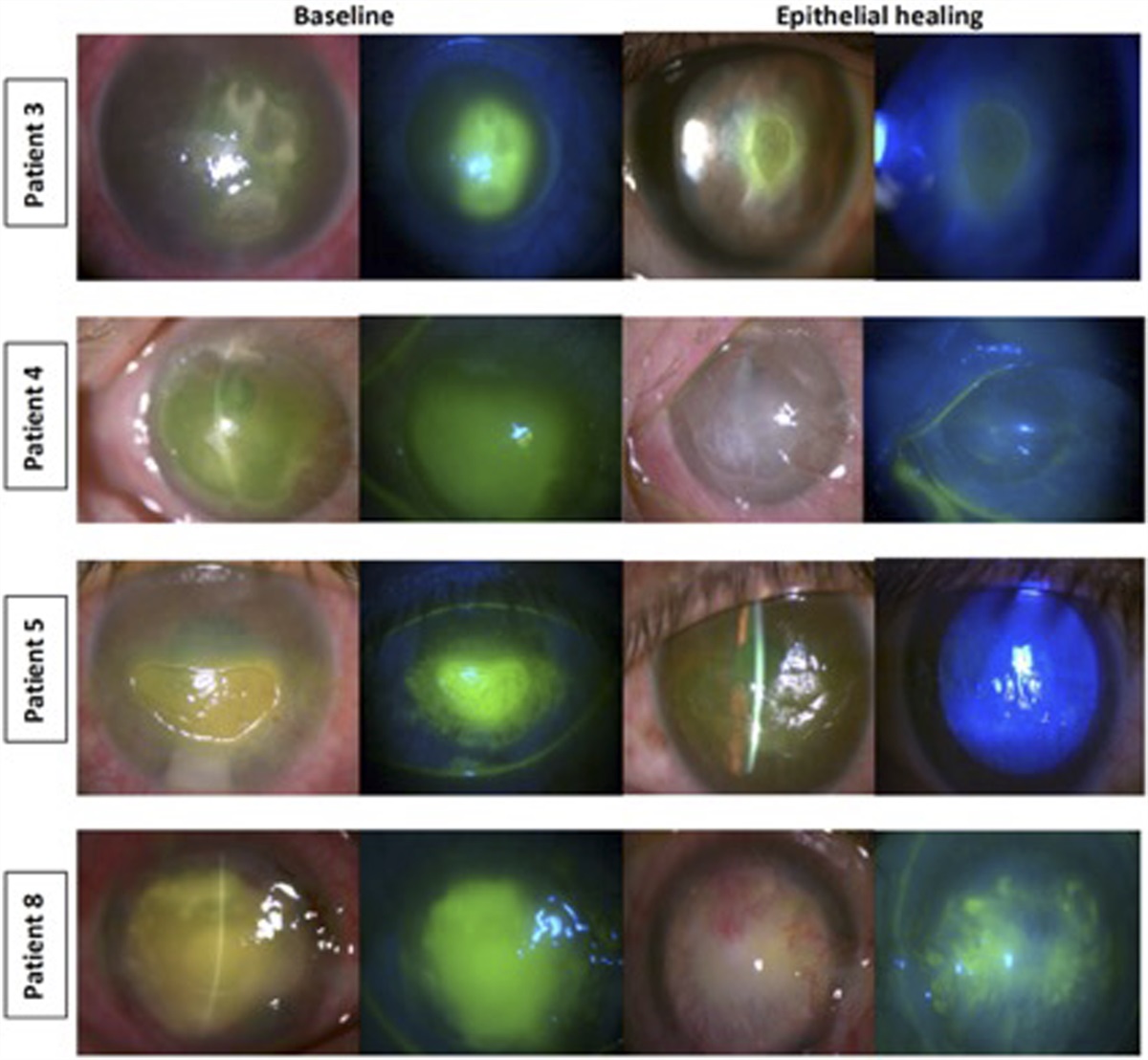 Concomitant Bandage Contact Lens, Oral Nicergoline, and Topical Autologous Serum for Severe Neurotrophic Keratitis