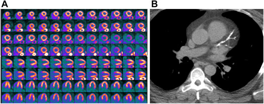 Obtaining a Coronary Artery Calcium Score with Myocardial Perfusion Imaging