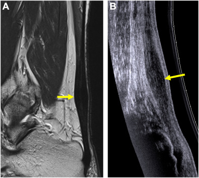 MR Imaging–Ultrasonography Correlation of Acute and Chronic Foot and Ankle Conditions