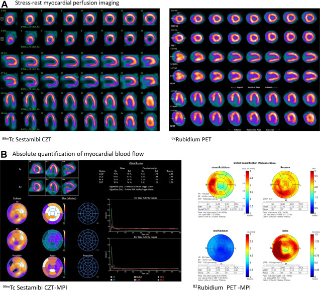 Radionuclide Tracers for Myocardial Perfusion Imaging and Blood Flow Quantification
