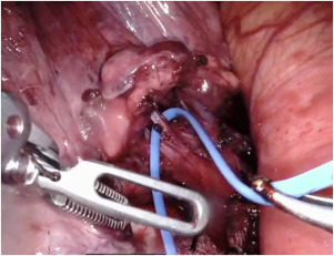 Sublobar Resections