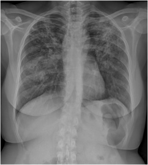 Sarcoidosis