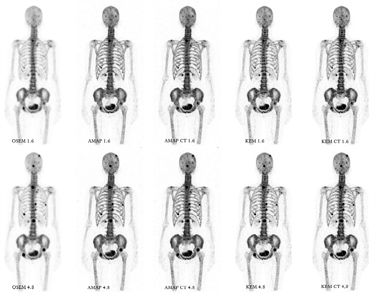 Anatomically guided reconstruction improves lesion quantitation and detectability in bone SPECT/CT