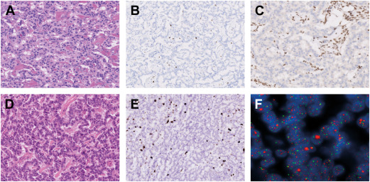 Status of Surveillance and Nonsurgical Therapy for Small Nonfunctioning Pancreatic Neuroendocrine Tumors