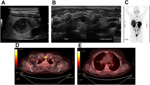 A Contemporary Review of the Treatment of Medullary Thyroid Carcinoma in the Era of New Drug Therapies