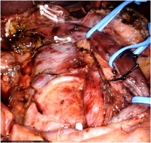 Minimally Invasive Pancreatectomy