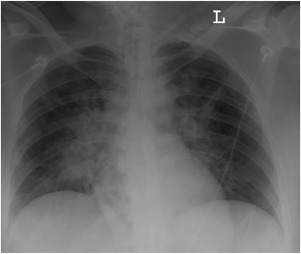 Acute Respiratory Distress Syndrome, Mechanical Ventilation, and Inhalation Injury in Burn Patients