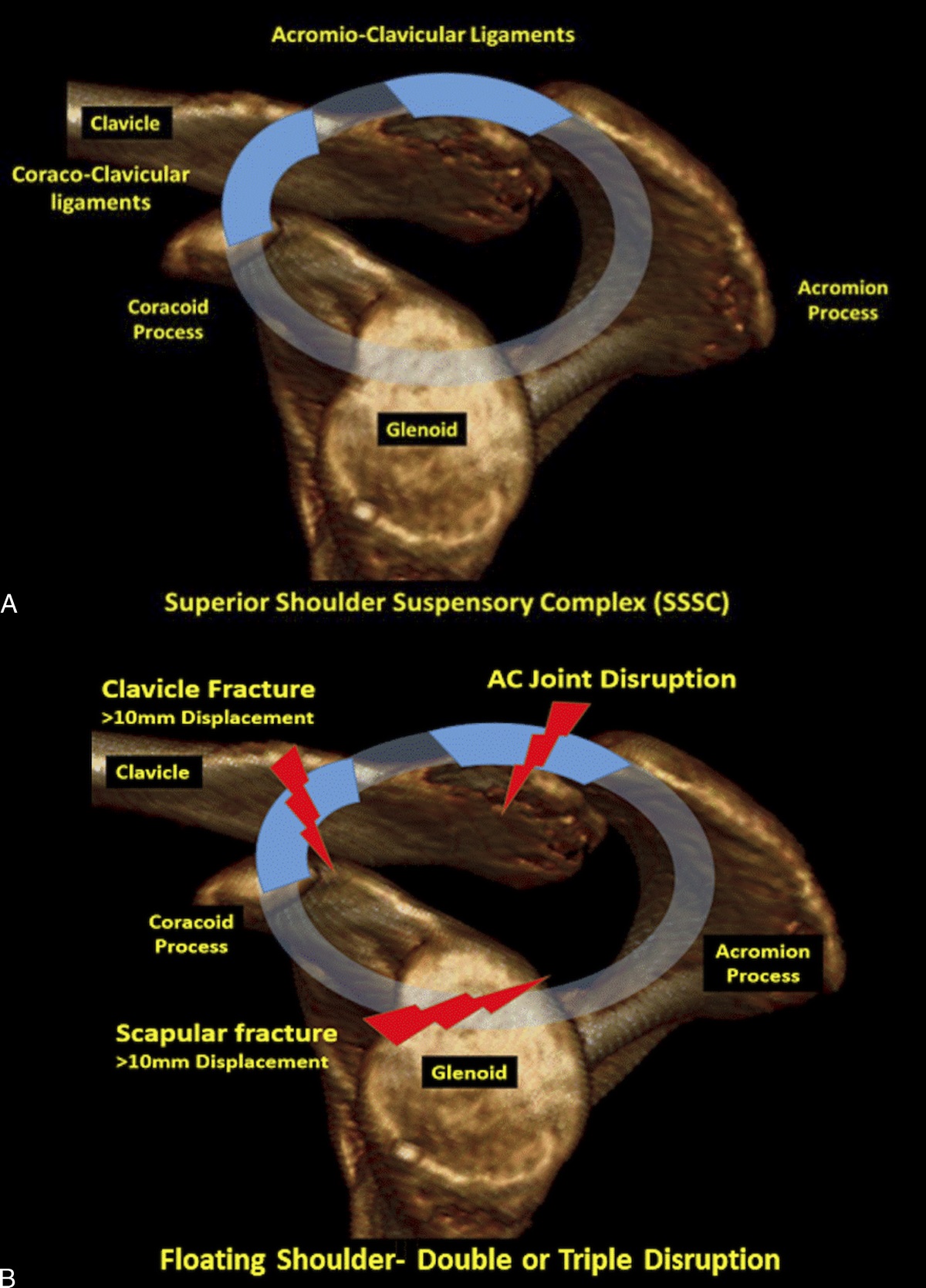 Musculoskeletal Computed Tomography: How to Add Value When Reporting Adult Upper Limb Trauma