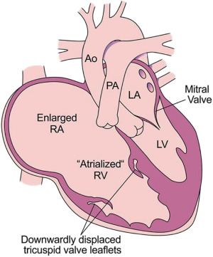 Valvular Regurgitation in Adults with Congenital Heart Disease and Heart Failure