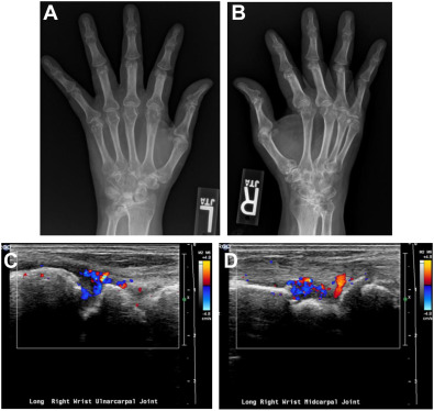 Spectrum of Hand Arthritis